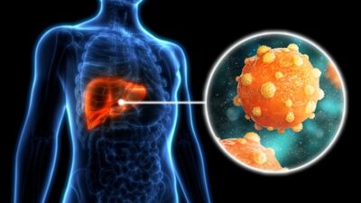 Indonesia Catat 1,4 Juta Kematian per Tahun Akibat Hepatitis